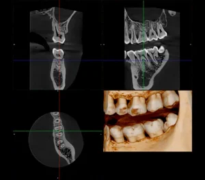 ENDO